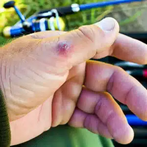 A close-up image of an angler's hand injuries in fly fishing​ showing a blister or minor cut, highlighting the kind of injuries often experienced by people during fishing action
